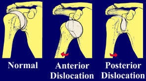 File:Dislocation Shoulder.jpg