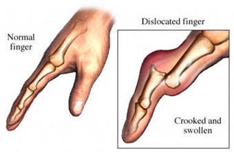 File:Dislocation Finger.jpg