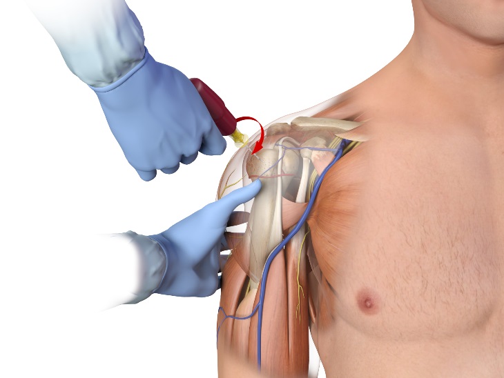 File:Humeral insertion.jpg