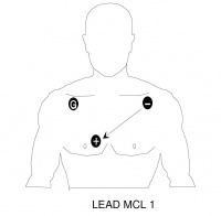 Placement for monitoring Lead MCL I