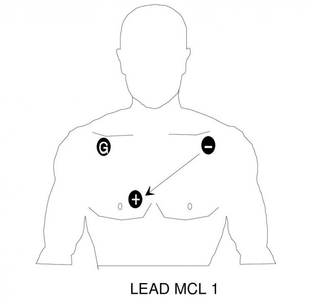 File:Cardiac MCL 1.jpg