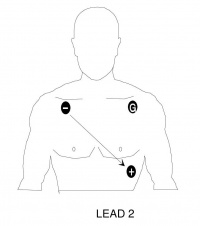 Placement for monitoring Lead II