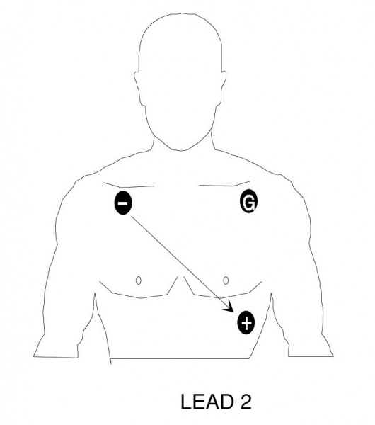 File:Cardiac Lead 2.jpg