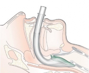 I Gel Airway Size Chart